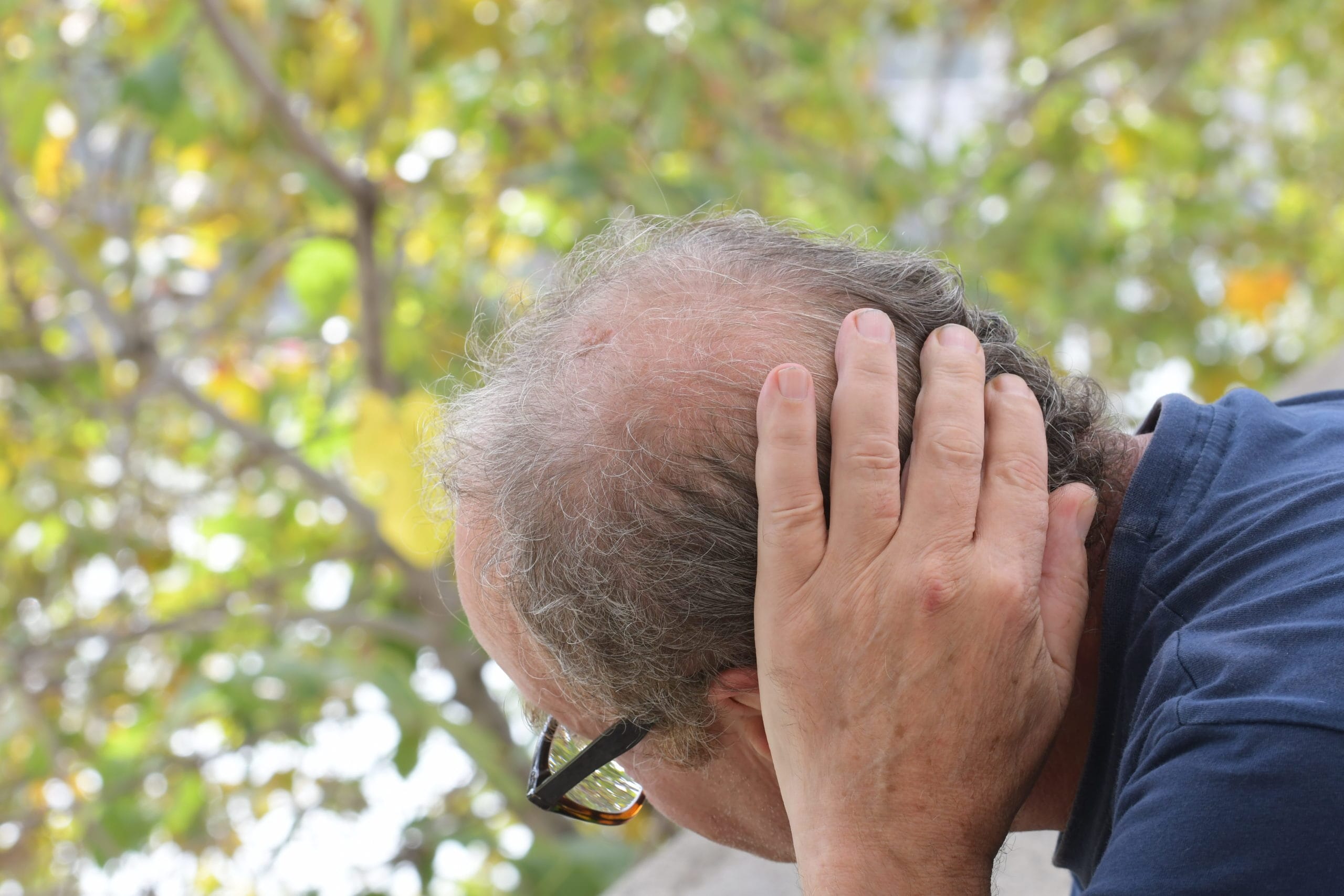 capelli, Quanto costa un trapianto di capelli