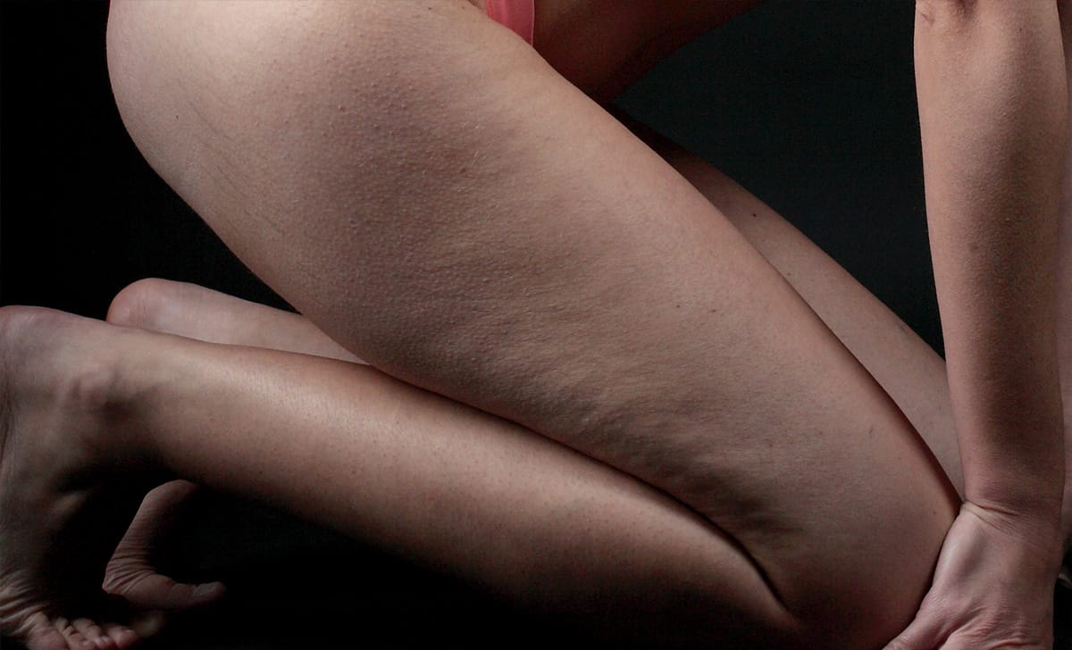 cellulite