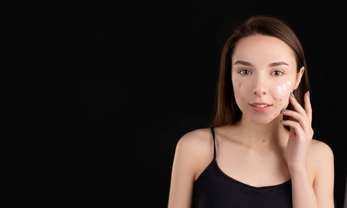 Addio a brufoli e punti neri