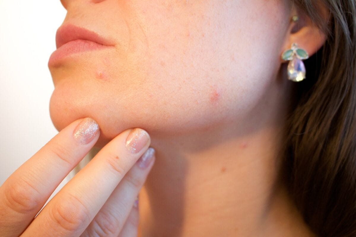 La vitamina B3 è utile anche contro l'acne